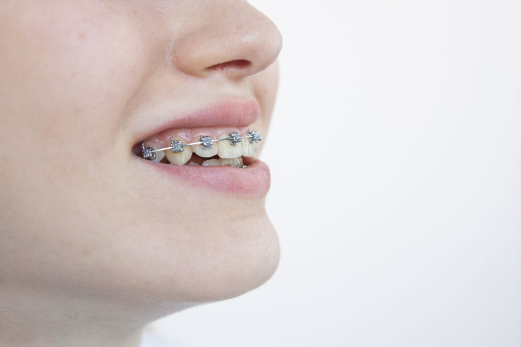 歯科医院で一般的に行われる、ワイヤーとブラケットを用いた矯正手法の細部