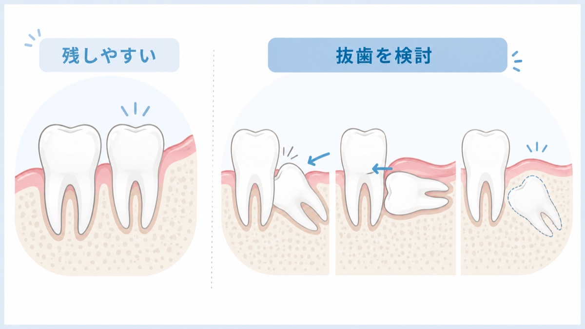 残しやすい親知らずと抜歯を検討する親知らずの生え方を比較した図